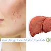 برای درمان اسهال چی بخوریم؟ خواص عرق کاسنی برای جوش صورت و درمان کبد