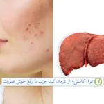 خواص عرق کاسنی برای جوش صورت و درمان کبد