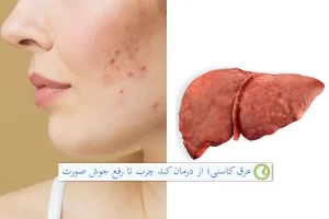 خواص عرق کاسنی برای جوش صورت و درمان کبد